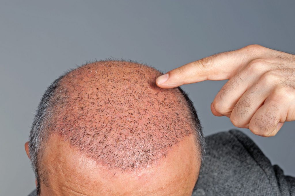 How Effective Hair Transplant is & Its Types