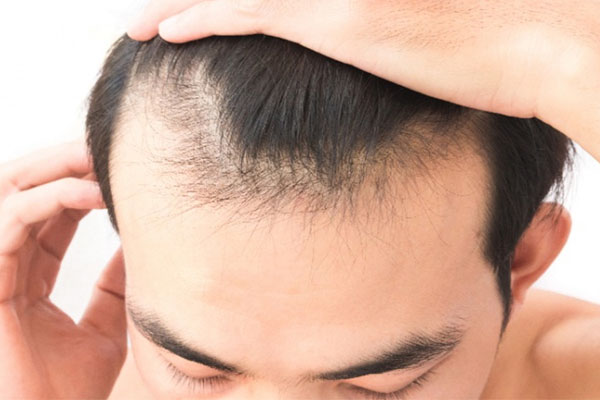 Knowing when you need hair fall treatment