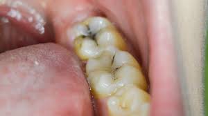 Top signs of tooth decay