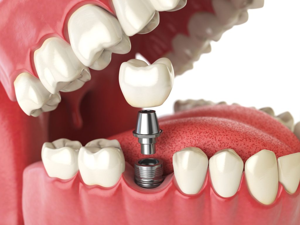 When Is Dental Implant Surgery Required?