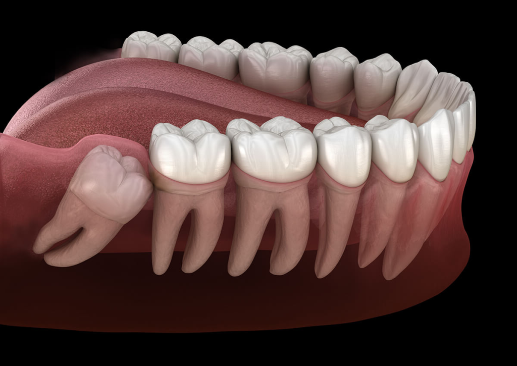 Is It Painful to Have Your Wisdom Teeth Extracted?