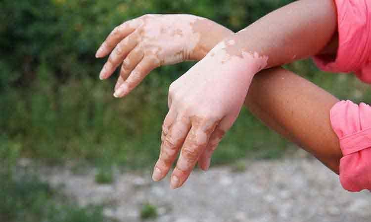 Common misconceptions and facts about Vitiligo:
