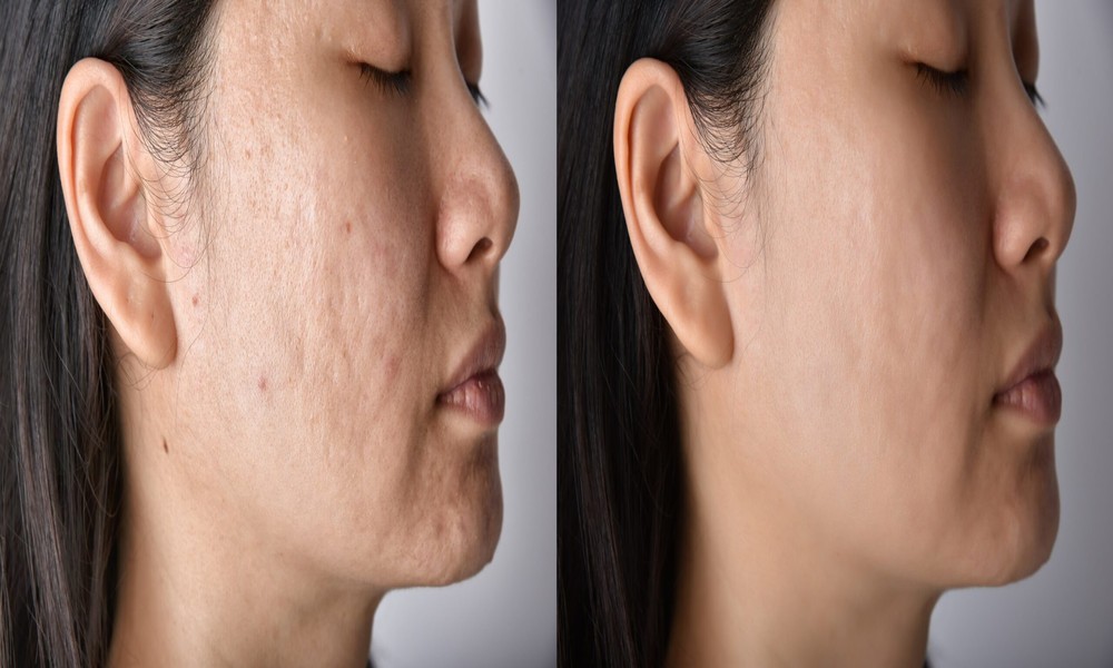 Advances in Scar Tissue Treatment Transforming Modern Skin Restoration Approaches